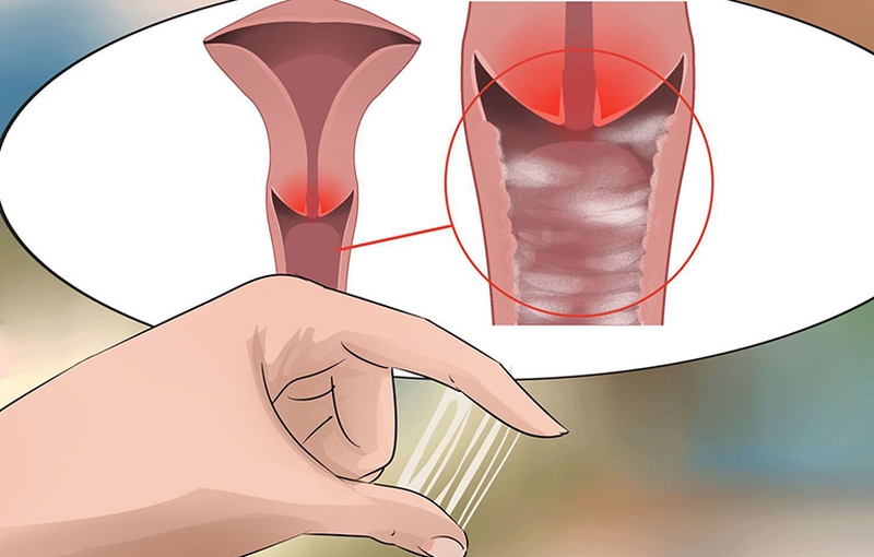 Triệu chứng bệnh lậu ở nữ giới bao gồm những gì? 1