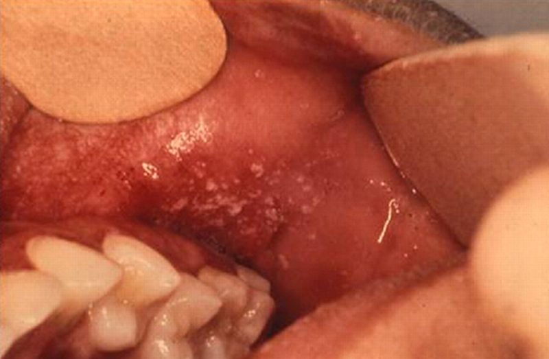 Tìm hiểu các triệu chứng bệnh sởi ở người lớn 2