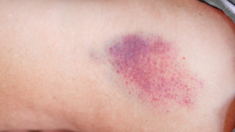 Triệu chứng bệnh sốt xuất huyết ở người lớn từ nhẹ đến nặng 3