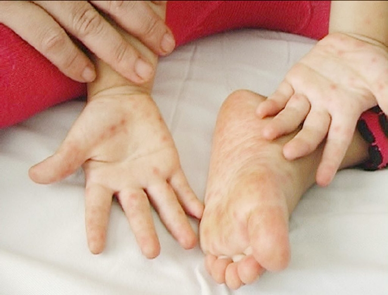 Cách sớm nhận biết triệu chứng bệnh tay chân miệng ở trẻ em 2