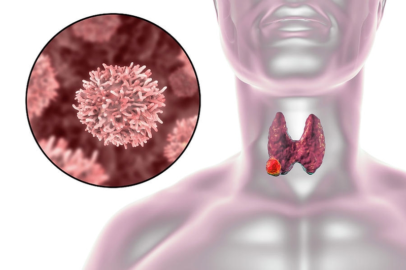 Triệu chứng bướu cổ ở tuổi dậy thì và cách điều trị 3