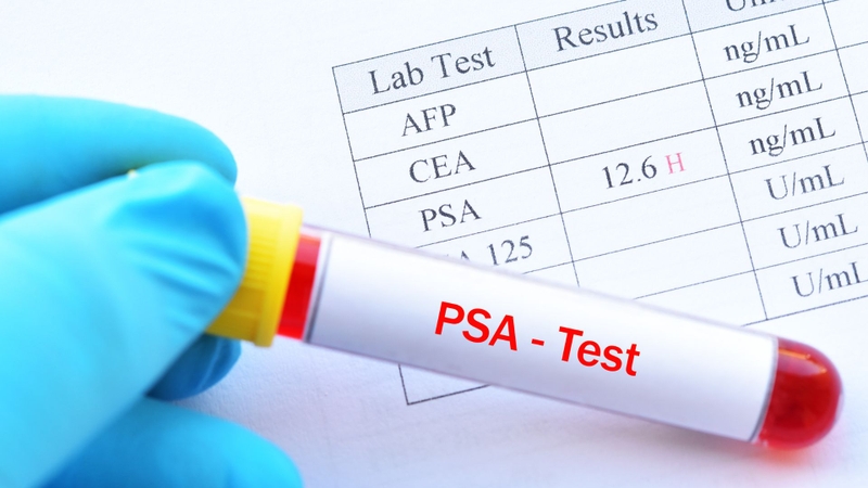 Xét nghiệm PSA huyết thanh giúp phân biệt rối loạn tiểu tiện do tăng sản lành tính hay bệnh lý ác tính tuyến tiền liệt
