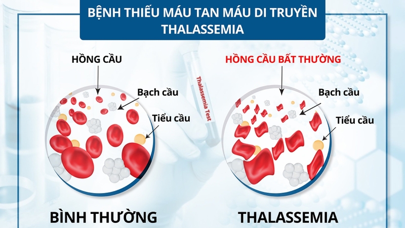 Triệu chứng của thiếu máu bẩm sinh là gì? 1