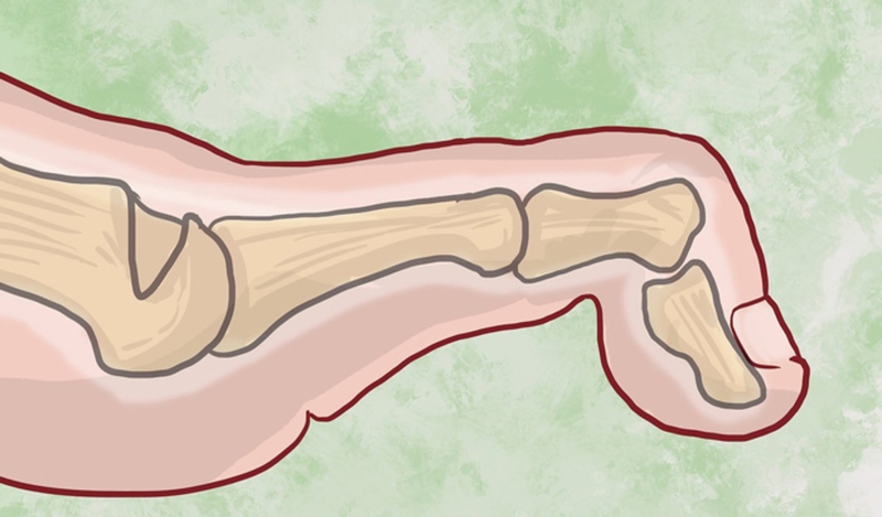 Triệu chứng đau khớp ngón chân cái và cách chữa trị 2