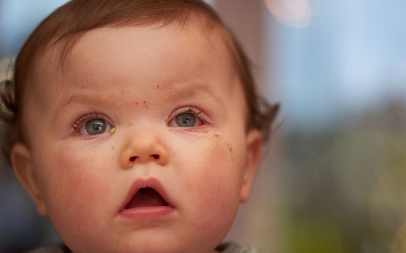 Triệu chứng đau mắt đỏ ở trẻ em nhận biết càng sớm càng tốt 2