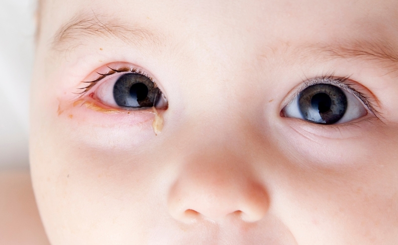 Triệu chứng đau mắt đỏ ở trẻ em nhận biết càng sớm càng tốt 1