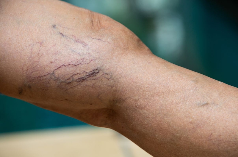 Tổng hợp các triệu chứng giãn tĩnh mạch không nên bỏ qua 2