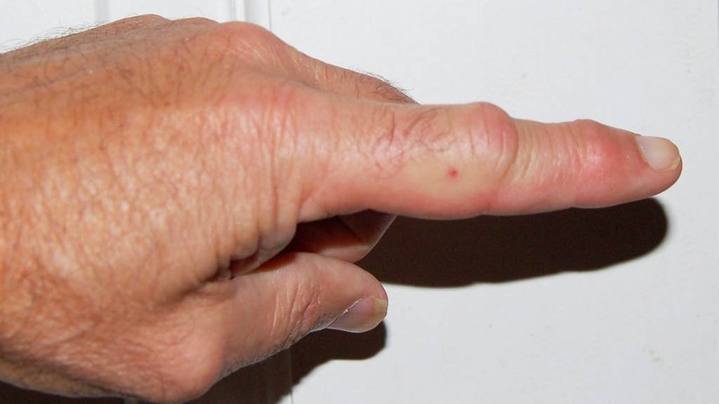 trieu-chung-khi-bi-ong-vo-ve-dot-va-nhung-dieu-can-luu-y 2.jpg