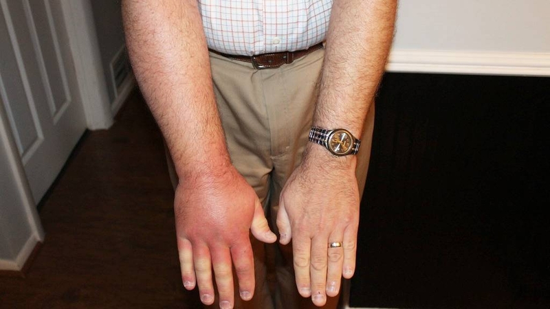 trieu-chung-khi-bi-ong-vo-ve-dot-va-nhung-dieu-can-luu-y 4.jpg