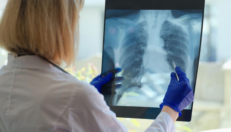 10 Triệu chứng lao phổi điển hình nhất cần lưu ý 2