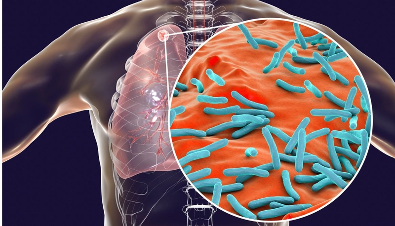 Triệu chứng lao phổi ở người lớn: 6 dấu hiệu cảnh báo không thể bỏ qua 2