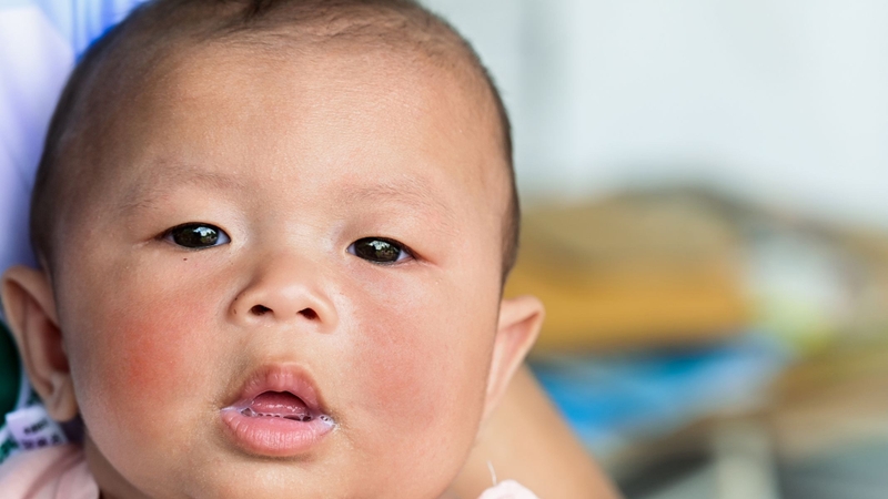 Triệu chứng Lupus ban đỏ ở trẻ em: Dấu hiệu cảnh báo cha mẹ không nên bỏ qua 1