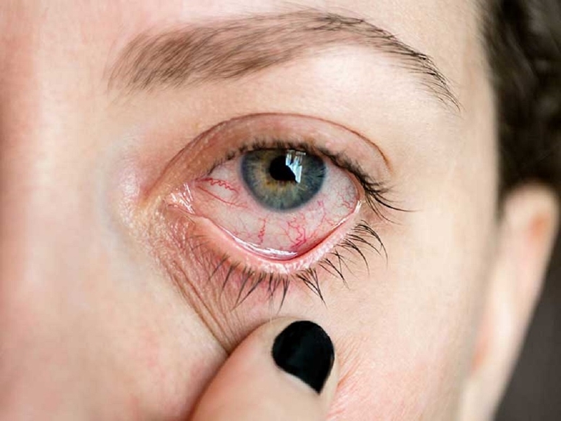 Tìm hiểu về bệnh lý viêm màng bồ đào có bị lây không? 2