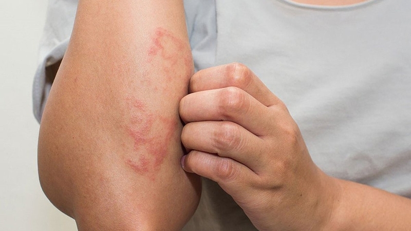 Triệu chứng nổi mụn nước ngứa khắp người là do đâu? 3