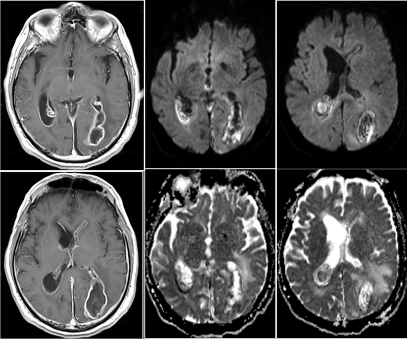 Triệu chứng sán chó lên não như thế nào?-2