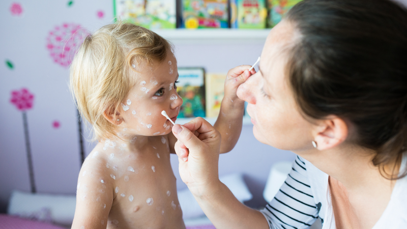 Triệu chứng sốt thủy đậu: Cách nhận biết và phòng ngừa 3