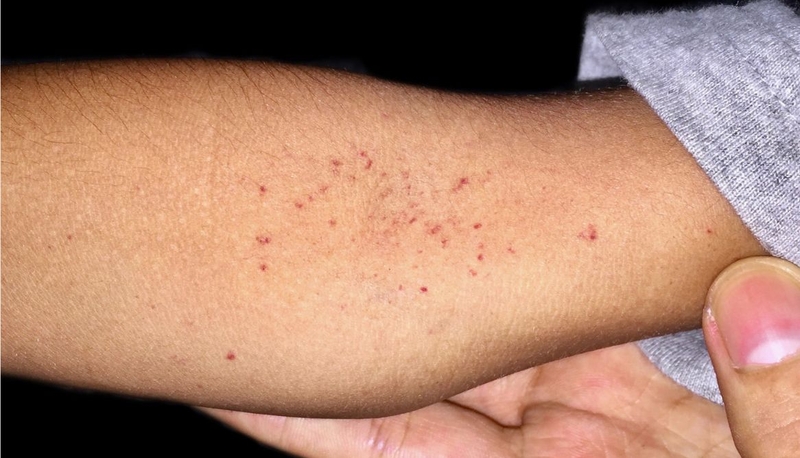 Nhận biết triệu chứng sốt xuất huyết nhẹ, cách theo dõi và chăm sóc 2