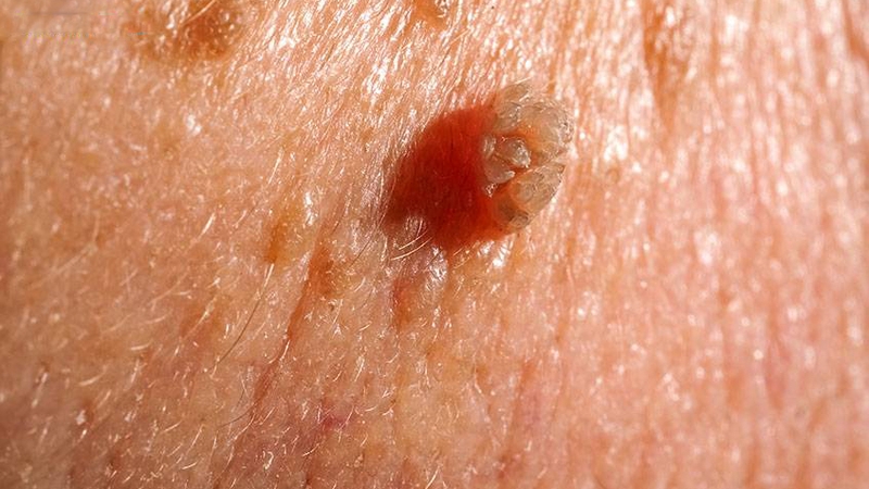 Cách chữa sùi mào gà ở nữ 3