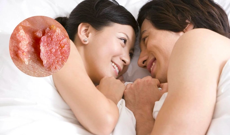 Triệu chứng sùi mào gà? Sùi mào gà có nguy hiểm không và cách chăm sóc? 1
