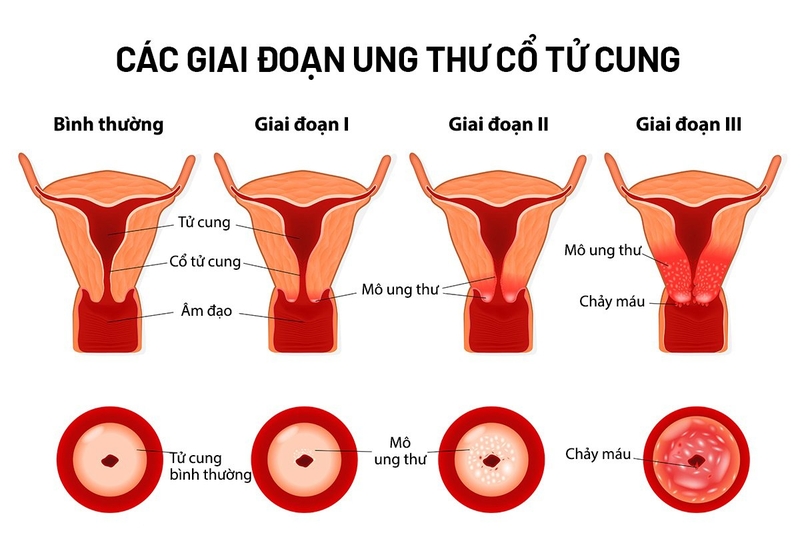 Triệu chứng sùi mào gà? Sùi mào gà có nguy hiểm không và cách chăm sóc? 3