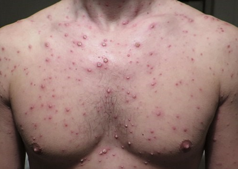 cac-trieu-chung-thuy-dau-thuong-gap-la-gi2