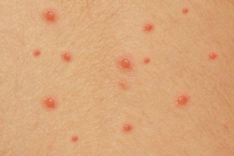 cac-trieu-chung-thuy-dau-thuong-gap-la-gi1