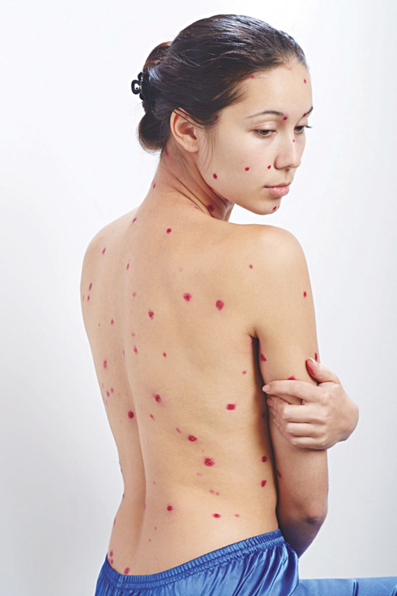 trieu-chung-thuy-dau-o-nguoi-lon-bieu-hien-nhu-the-nao2