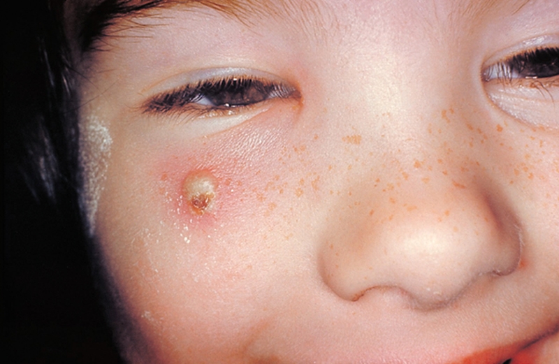 trieu-chung-thuy-dau-o-nguoi-lon-bieu-hien-nhu-the-nao3