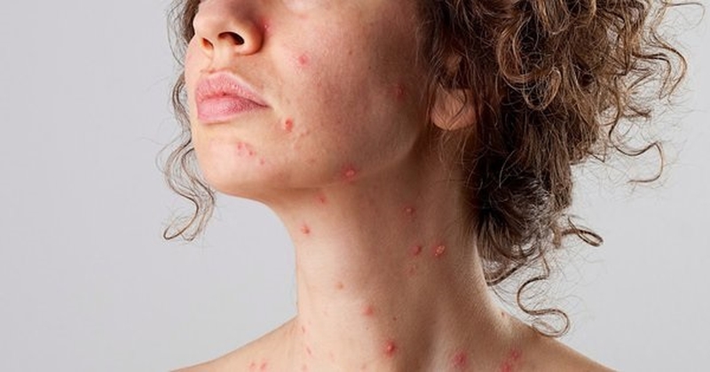 trieu-chung-thuy-dau-o-nguoi-lon-bieu-hien-nhu-the-nao1