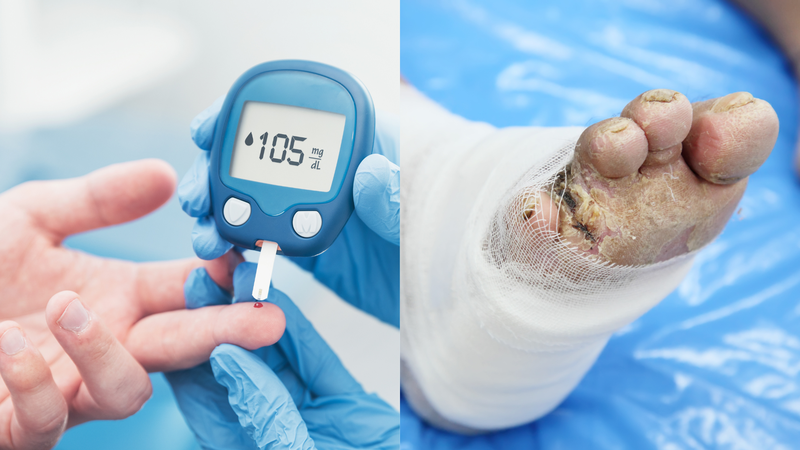11 triệu chứng tiểu đường giai đoạn đầu: Loét bàn chân
