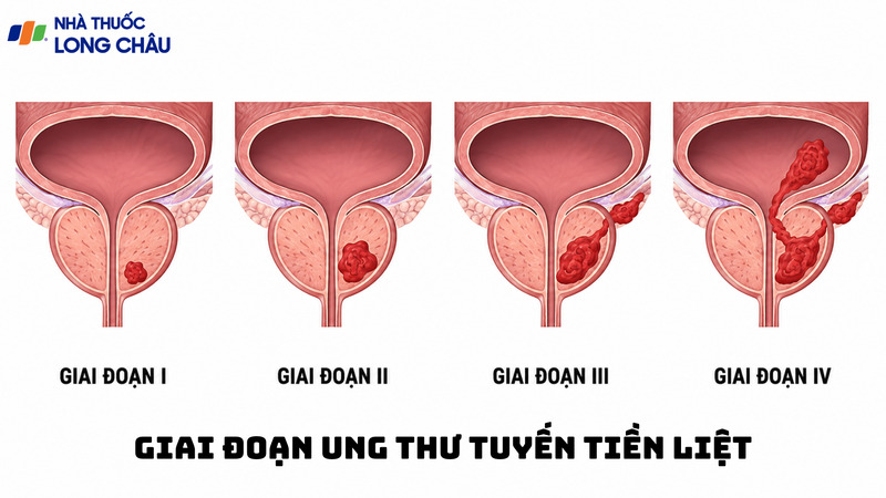 Bệnh giai đoạn sớm thường ít triệu chứng và dễ nhầm với phì đại tuyến tiền liệt