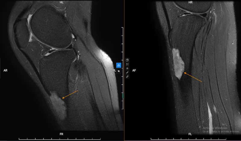 Triệu chứng ung thư xương đầu gối mà bạn nên biết 5