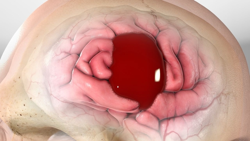 Triệu chứng và cách điều trị máu tụ dưới màng cứng mạn tính 1