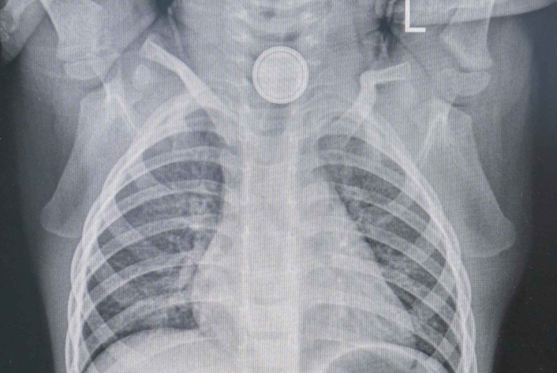 Triệu chứng và cách xử trí dị vật đường ăn 2