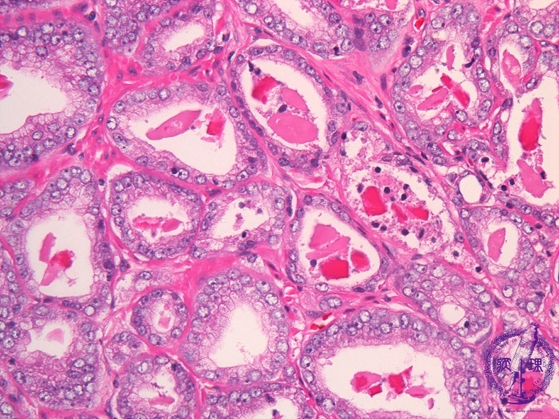 Triệu chứng và phân loại u tế bào mầm ở trẻ em - Bạn đã biết chưa? 2