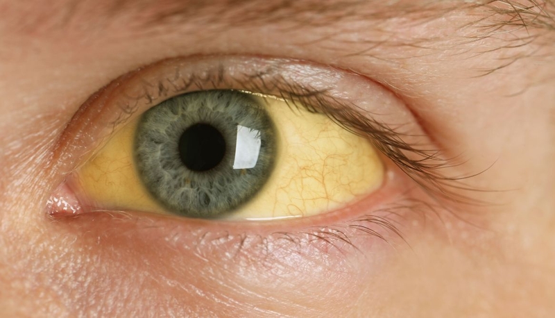 Cần cảnh giác cao độ với những triệu chứng viêm tụy cấp này 2