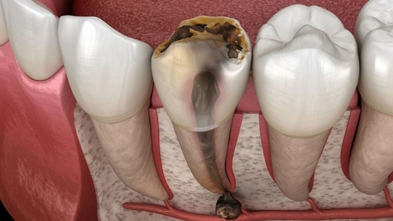 Sâu răng không điều trị là nguyên nhân hàng đầu gây viêm tủy răng