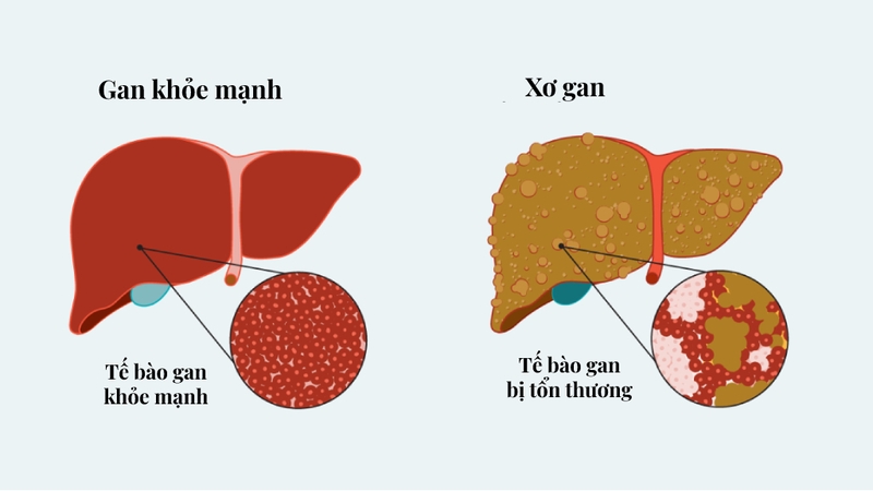 Triệu chứng xơ gan là gì? Cách phát hiện sớm bệnh xơ gan 1