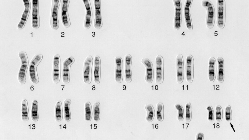 Nguyên nhân chính dẫn đến Trisomy 18 là sự bất thường trong phân chia nhiễm sắc thể