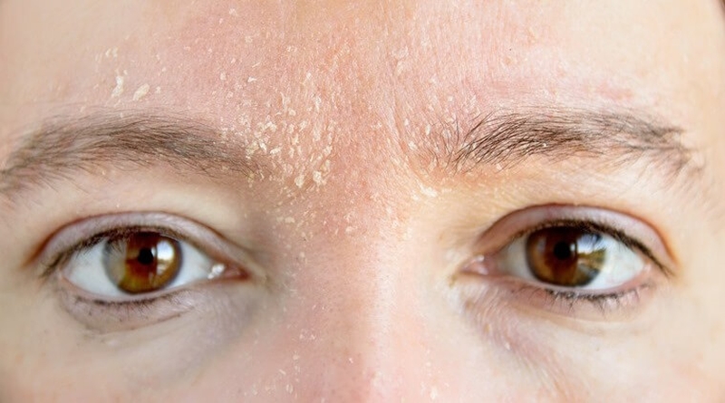 Biểu hiện da khô bong tróc