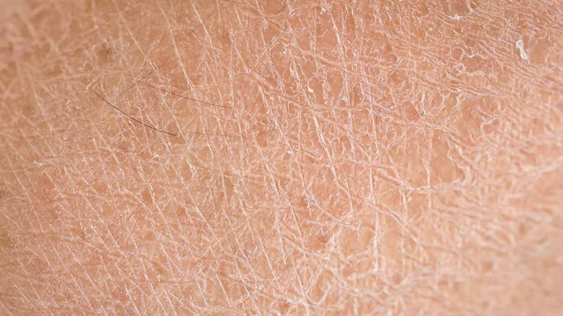 Trời lạnh da khô&nbsp;là tình trạng rất nhiều người gặp phải