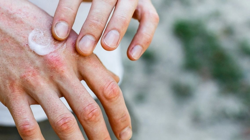 Chăm sóc da bên ngoài, bổ sung nước và dưỡng chất giúp cải thiện da khô