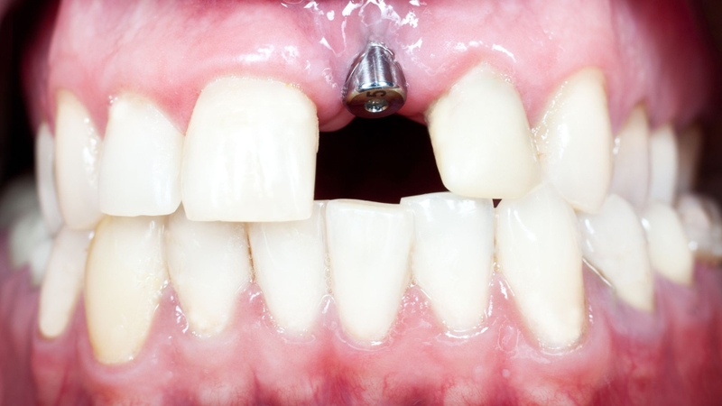 Trồng 4 răng cửa​ liên tiếp nên chọn phương pháp nào? 2