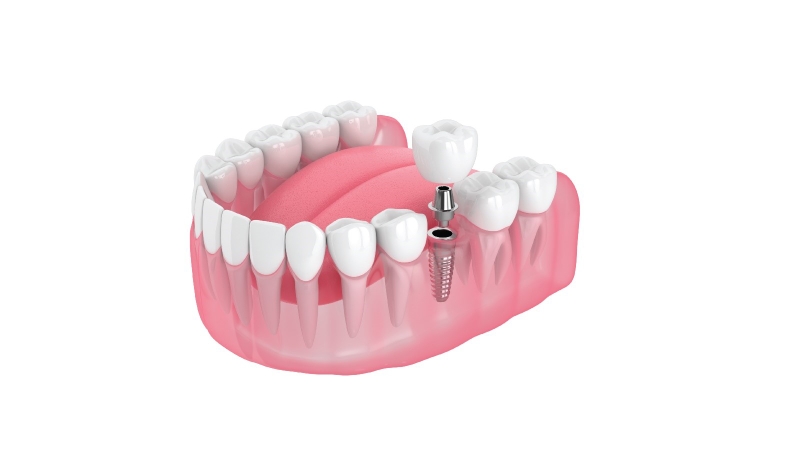 Trồng răng bằng cấy ghép implant có thật sự tốt? 1