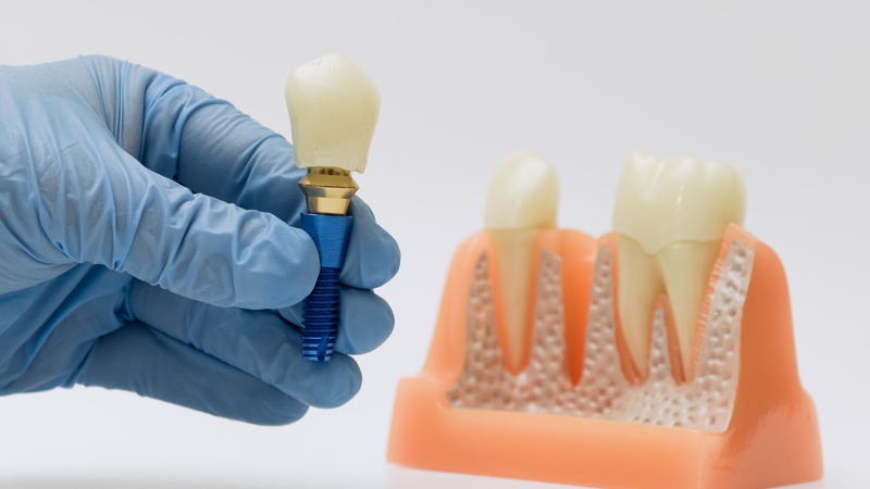 Số lượng răng cần trồng ảnh hưởng trực tiếp đến chi phí phục hình