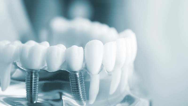 Trồng răng hàm số 6 giá bao nhiêu​? Nên trồng bằng phương pháp nào? 2