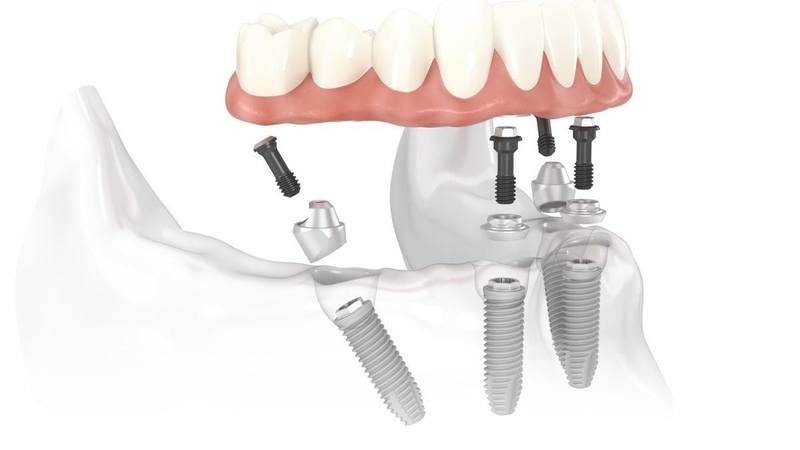 Phương pháp trồng răng Implant All-on-4 ra đời từ năm 1998