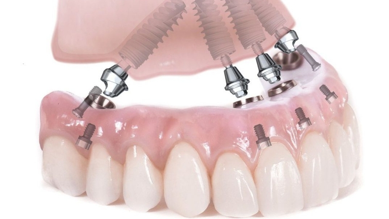 Giải đáp trồng răng Implant All-on-4 giá bao nhiêu tiền