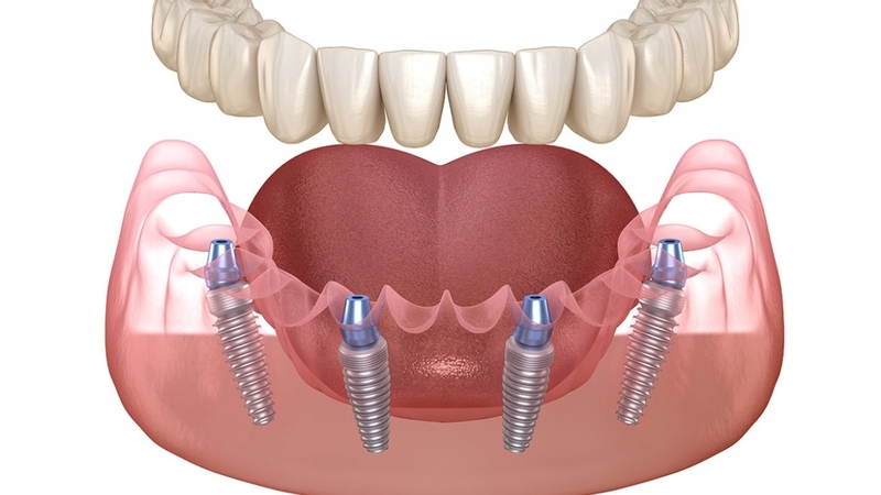 Chi phí trồng răng Implant All-on-4 gồm nhiều hạng mục