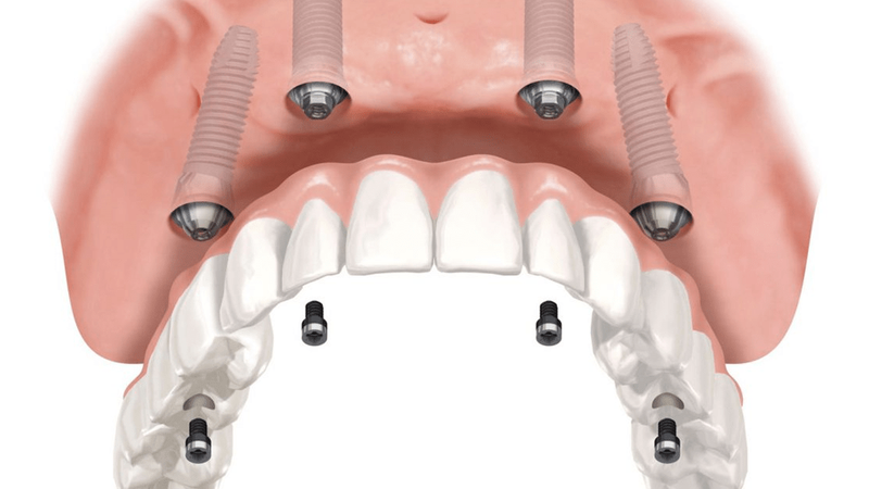 Nhiều nguyên nhân dẫn đến chi phí trồng răng Implant All-on-4 đắt đỏ